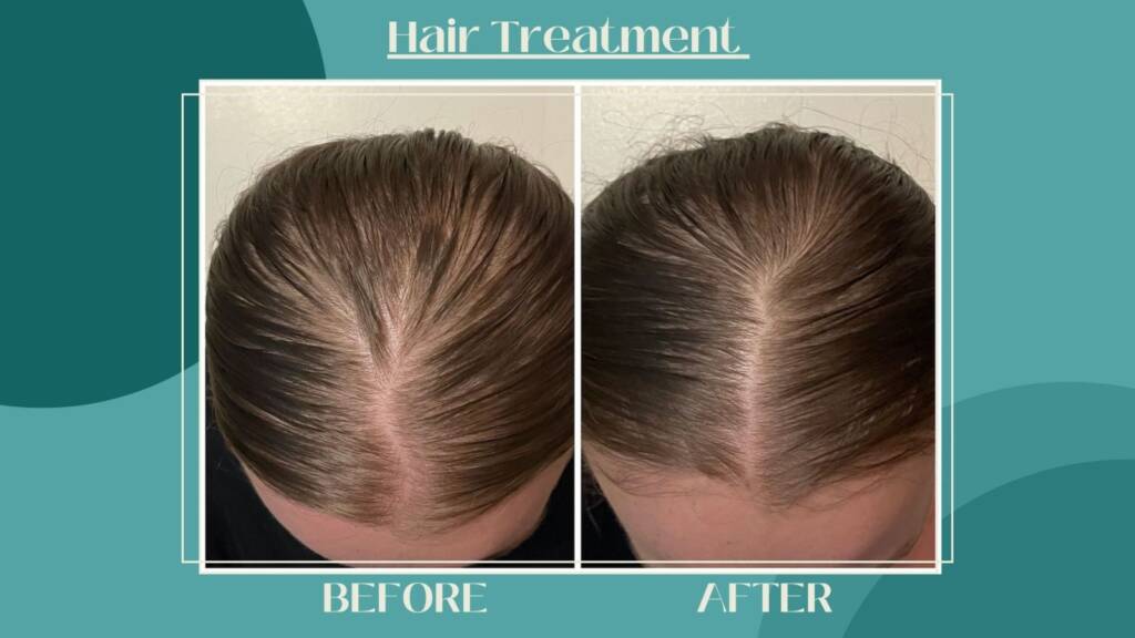 Hair Treatment in Dubai