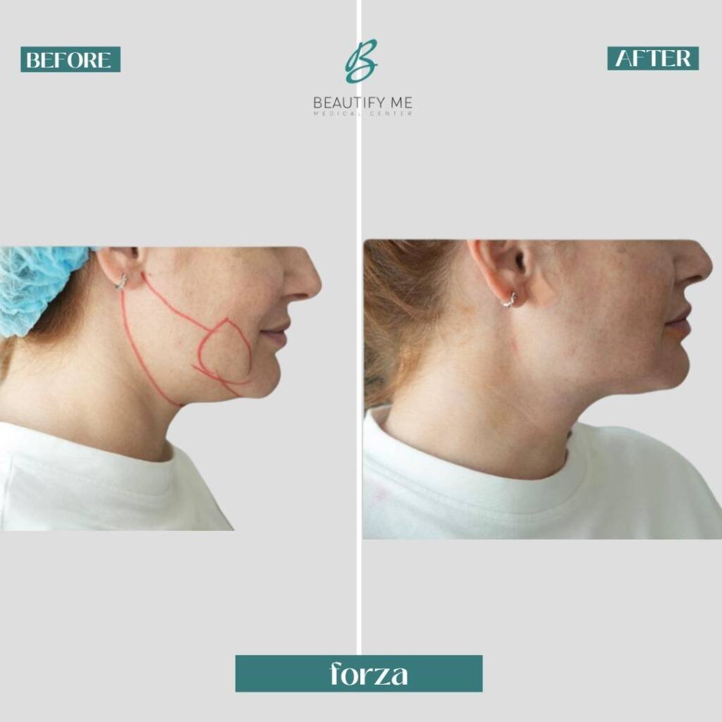 double chin removal